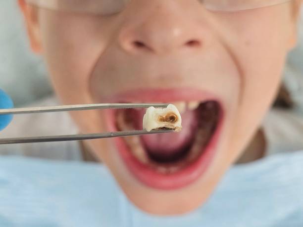 Best Broken or Cracked Tooth Emergency Dentist in Forest City, NC